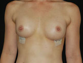 Patient # 35211 After Photo # 2